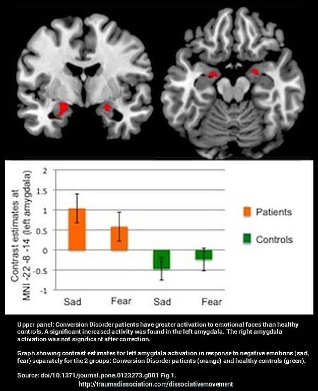 Neuroimaging in Conversion Disorder from traumadissociation.com - sad and fearful faces cause different responses in Conversion Disorder